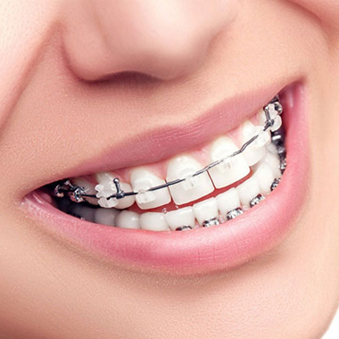 Aparelhos Ortodônticos
