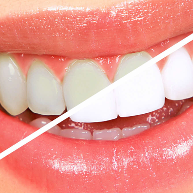 Clareamento Dental