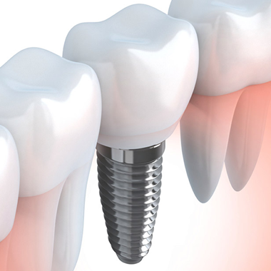 Implantes Dentários