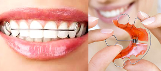 Aparelhos removíveis